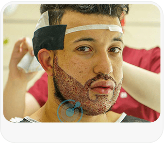 Who Is an Ideal Candidate for a Beard Transplant in Turkey